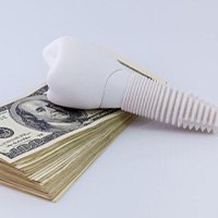 Dental implant sitting on a stack of money