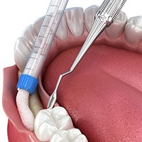 Illustration of bone grafting