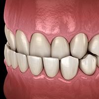 Illustration of underbite