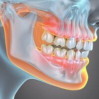 an illustration of an xray of the tmj